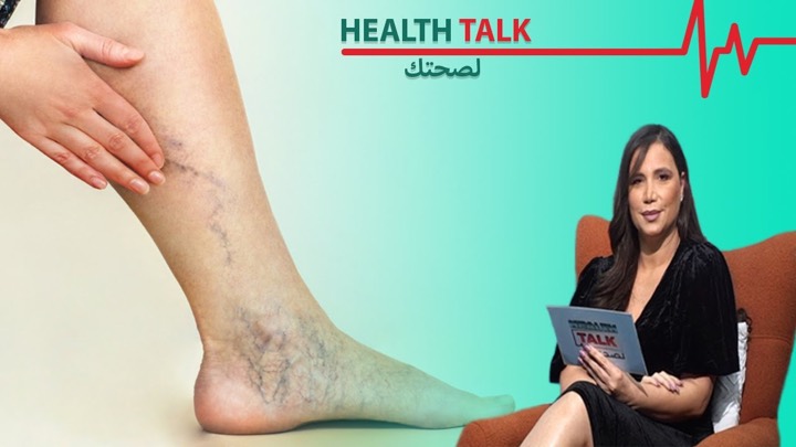 Dr. Alain Shab interviewed on OTV Lebanon, Health Talk: the causes of leg varicose veins